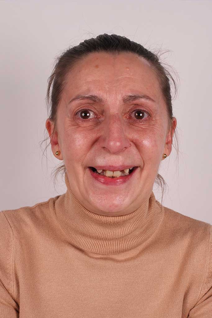 antes-del-caso-de-exito-implantes-dentales-en-vigo